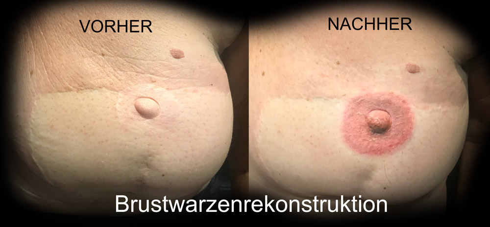 Brustwarzenrekonstruktion OL INK